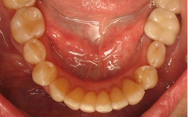 After Invisalign: aligned lower teeth