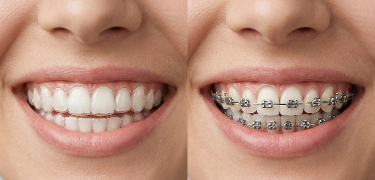 Side by side comparison of a smile with Invisalign clear aligners and a smile with traditional metal braces