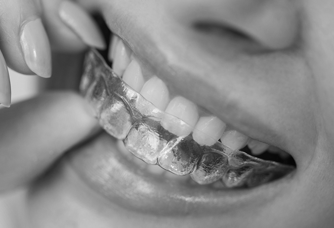 Invisalign clear aligner treatment for Thousand Oaks patients
