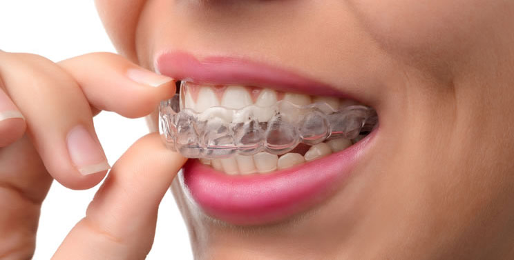 INVISALIGN®