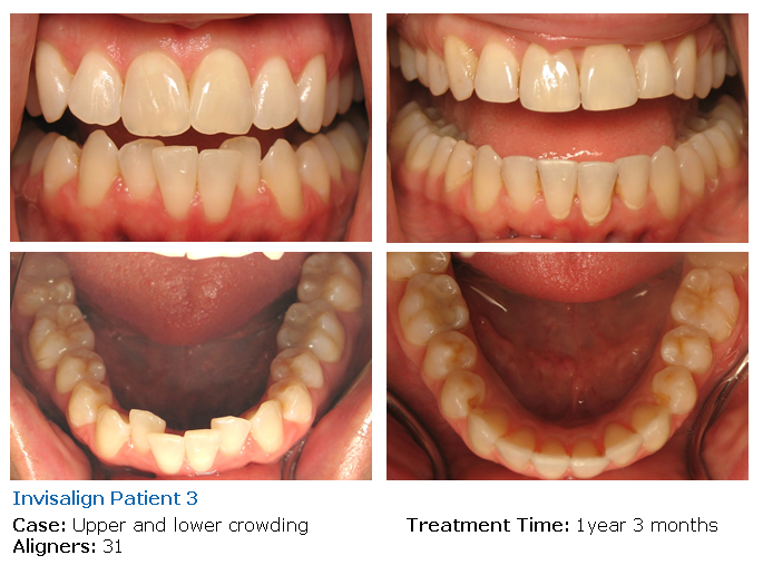 Before & After Photos, Invisalign Clear Aligners Gallery